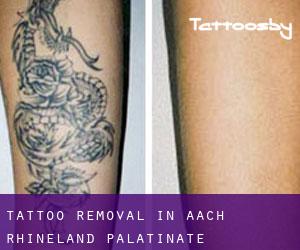 Tattoo Removal in Aach (Rhineland-Palatinate)