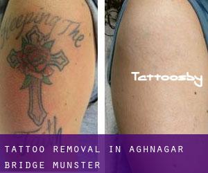 Tattoo Removal in Aghnagar Bridge (Munster)