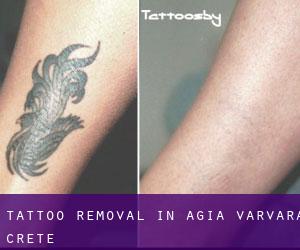 Tattoo Removal in Agía Varvára (Crete)