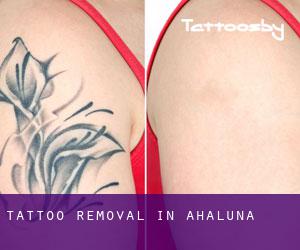 Tattoo Removal in Ahaluna