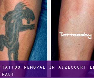 Tattoo Removal in Aizecourt-le-Haut
