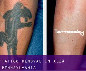 Tattoo Removal in Alba (Pennsylvania)