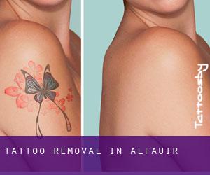 Tattoo Removal in Alfauir