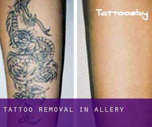 Tattoo Removal in Allery