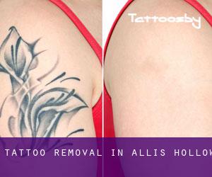 Tattoo Removal in Allis Hollow