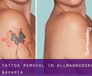 Tattoo Removal in Allmannsdorf (Bavaria)