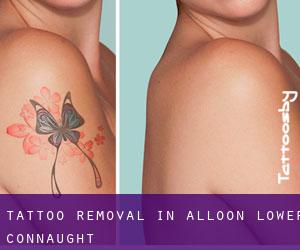 Tattoo Removal in Alloon Lower (Connaught)