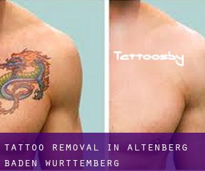 Tattoo Removal in Altenberg (Baden-Württemberg)