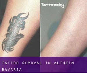 Tattoo Removal in Altheim (Bavaria)