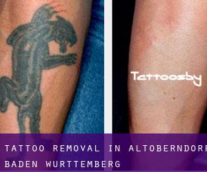 Tattoo Removal in Altoberndorf (Baden-Württemberg)