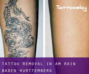 Tattoo Removal in Am Rain (Baden-Württemberg)