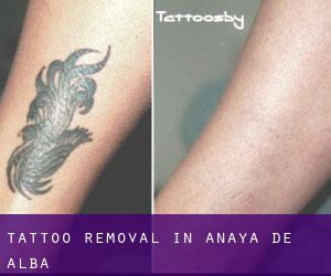 Tattoo Removal in Anaya de Alba