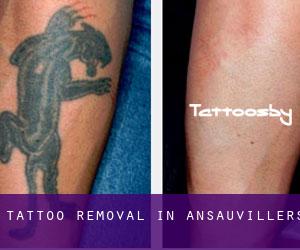 Tattoo Removal in Ansauvillers