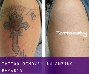 Tattoo Removal in Anzing (Bavaria)