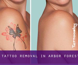 Tattoo Removal in Arbor Forest