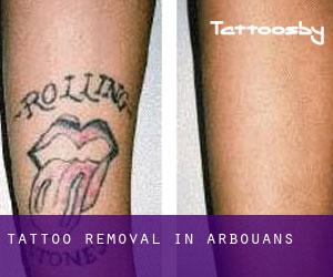 Tattoo Removal in Arbouans