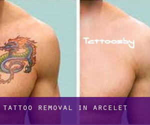 Tattoo Removal in Arcelet