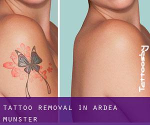 Tattoo Removal in Ardea (Munster)