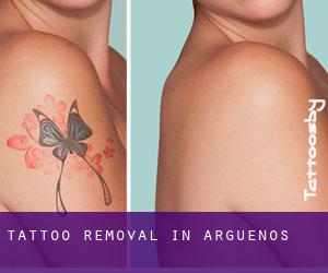 Tattoo Removal in Arguenos