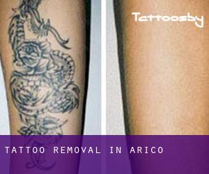 Tattoo Removal in Arico