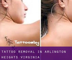 Tattoo Removal in Arlington Heights (Virginia)
