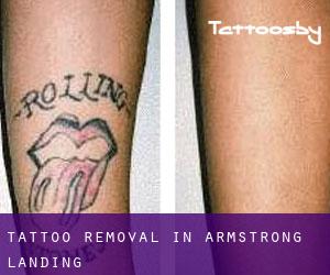 Tattoo Removal in Armstrong Landing