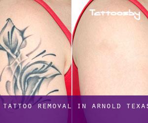 Tattoo Removal in Arnold (Texas)