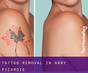 Tattoo Removal in Arry (Picardie)