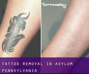 Tattoo Removal in Asylum (Pennsylvania)