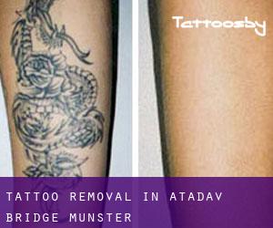 Tattoo Removal in Atadav Bridge (Munster)