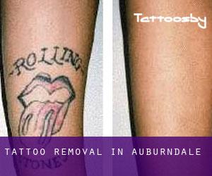 Tattoo Removal in Auburndale