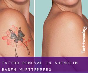 Tattoo Removal in Auenheim (Baden-Württemberg)