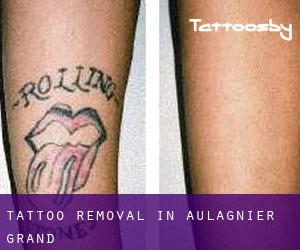 Tattoo Removal in Aulagnier Grand