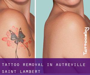 Tattoo Removal in Autréville-Saint-Lambert