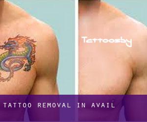 Tattoo Removal in Avail