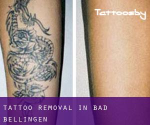 Tattoo Removal in Bad Bellingen