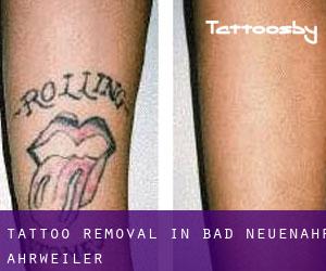 Tattoo Removal in Bad Neuenahr-Ahrweiler