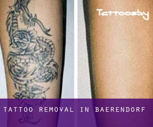 Tattoo Removal in Baerendorf