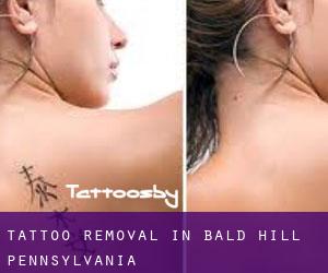 Tattoo Removal in Bald Hill (Pennsylvania)