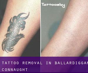 Tattoo Removal in Ballardiggan (Connaught)