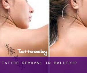 Tattoo Removal in Ballerup