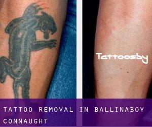 Tattoo Removal in Ballinaboy (Connaught)