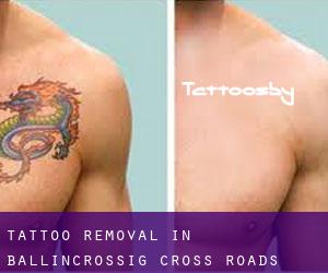 Tattoo Removal in Ballincrossig Cross Roads (Munster)