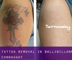 Tattoo Removal in Ballinillann (Connaught)