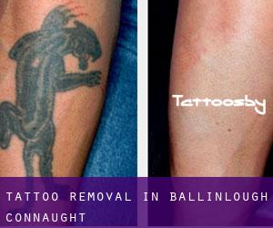 Tattoo Removal in Ballinlough (Connaught)