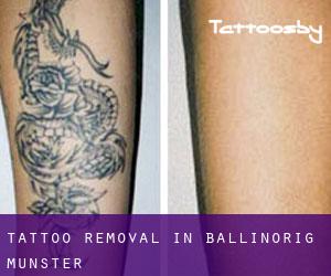 Tattoo Removal in Ballinorig (Munster)