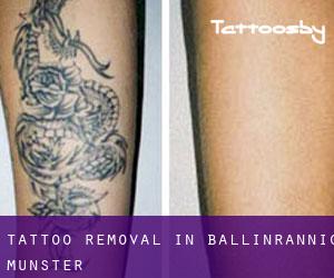 Tattoo Removal in Ballinrannig (Munster)