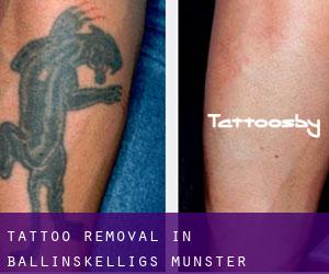 Tattoo Removal in Ballinskelligs (Munster)