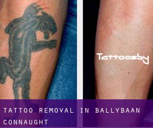 Tattoo Removal in Ballybaan (Connaught)