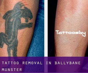 Tattoo Removal in Ballybane (Munster)